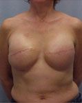 after breast reconstruction