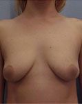before breast augmentation