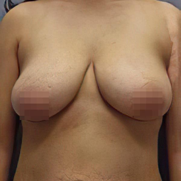 before breast lift