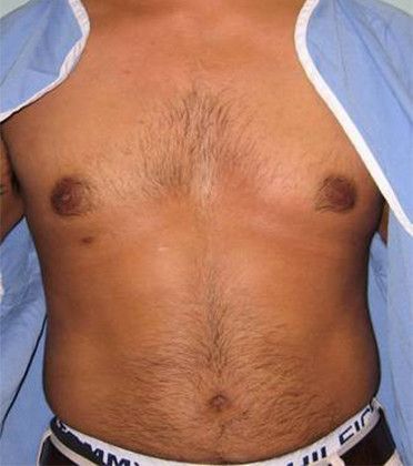 After liposuction
